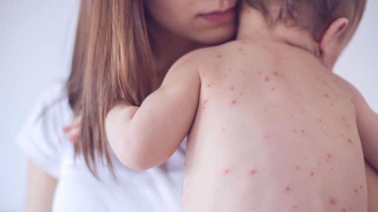 Measles, one of the world’s most infectious diseases, is making a global comeback despite decades of progress in vaccination and public health awareness.